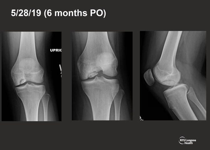 Cartilage Case of the Month - KM