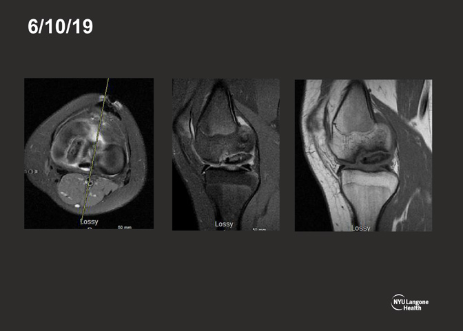 Cartilage Case of the Month - KM