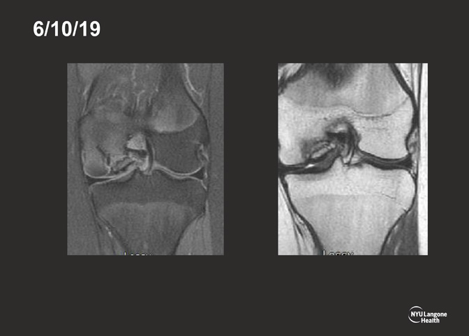 Cartilage Case of the Month - KM